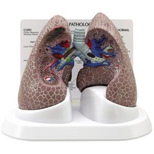 COPD Lung Cancer GPI Anat