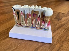 Zahnmodell Zahnerkrankungen 3D