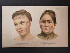 Chromolithografie von 1890. Schuppenflechte und Zerstörung durch Syphilis. --Hei