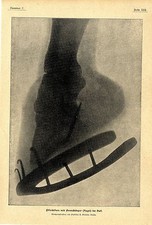 Pferdefuss mit Fremdkörper Prof. R. Eberlein Berlin Histor.Röntgenaufnahmen 1901