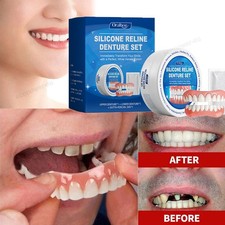 Veneers in den Zähnen