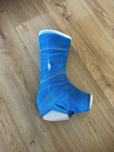 Gipsfuß gipsbein slwc - gipsfuß,