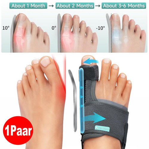 Hallux valgus korrektur - hallux,