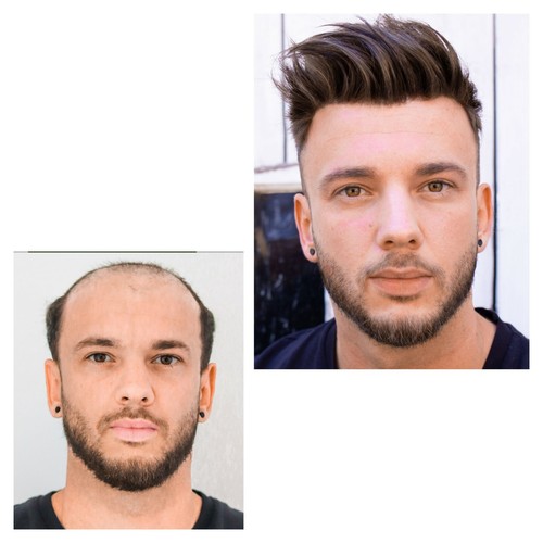 Haarsystem extrem dünne - ,