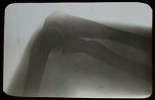 Magic Lantern Slide ELBOW