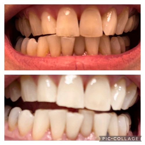 Very strong teeth whitening - teeth,