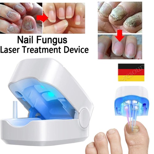 Laser nagelpilz fungal nail - laser,