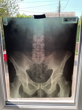 3 x Vintage X Ray Medical Body Hip Rare X Ray Negative Photo = 1973