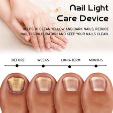  Nagel Behandlungslampe Für