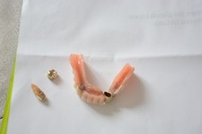 Zahngold  mit Zahnresten 