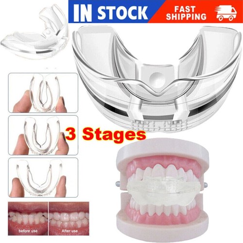 Erwachsene zahnspange retainer - zahnspange,