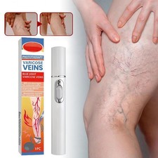 Krampfadern Behandlungsgerät