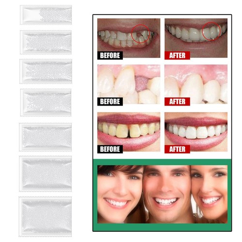 Thermoperlen zähne veneers - thermoperlen,