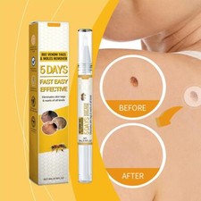 Bienengift-Stift zur Warzen-