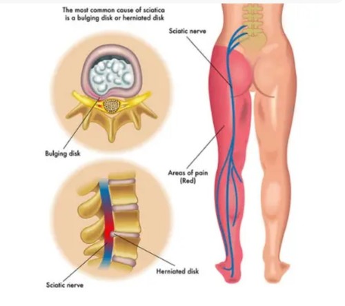 Ischias schmerzen öl - schmerzen, massage