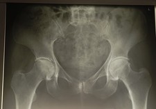 je 1 Original Röntgenbild