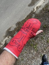 Gipsarm SAFS Weissgips links