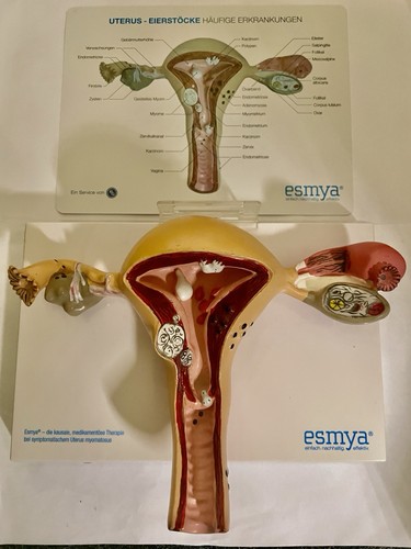 Uterusmodell mit erkrankungen - uterusmodell,