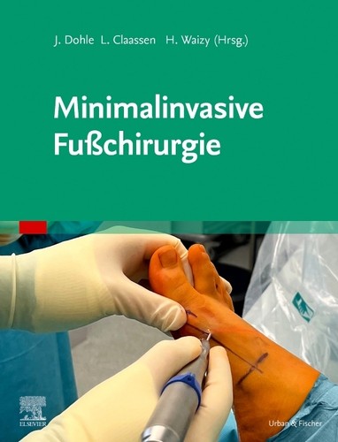 Minimalinvasive fußchirurgie - minimalinvasive,