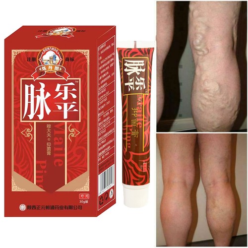 Chinese krampfadern behandlung - chinese,