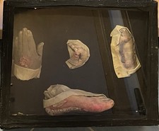 WACHSMOULAGE SEHR ALT, HAUTKRANKHEITEN DERMATOLOGIE DDR