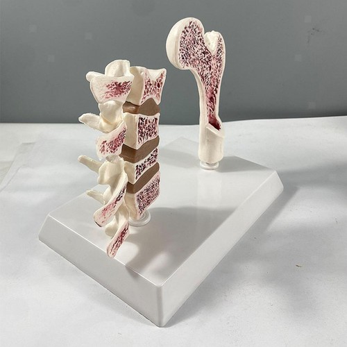 Human femur osteoporosis - femur,