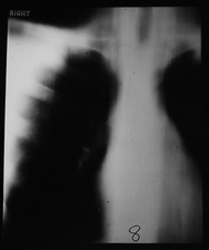 MENSCHLICHE BRUST RECHTE SEITE