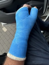 Gipsarm SATS links Kunststoffgips hellblau 4,5 Wochen getragen