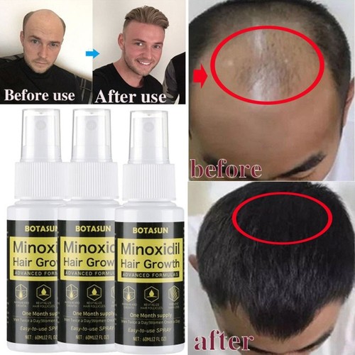 Minoxidil extra stärke - 5%,