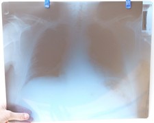 3 Vintage Brust-Röntgenstrahlen - Medizinischer PA-Brust-Radiograph - nicht digitaler einfacher Film X3