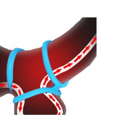 Silikon Penisring Penisringe