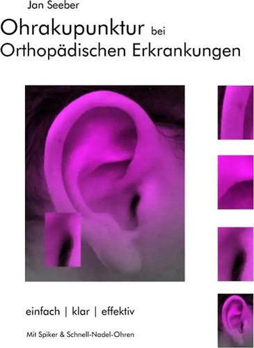 Ohrakupunktur bei