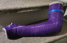 Gipsarm Oberarmgips Lila Links