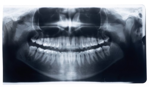 Original dental röntgenfilm - dental,