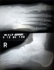 Original Vintage 1960 Hospital X Ray Human Foot Acetate Film Harley Street #C