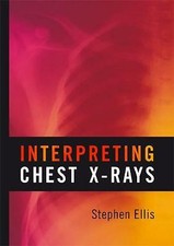 Interpreting Chest X-Rays by