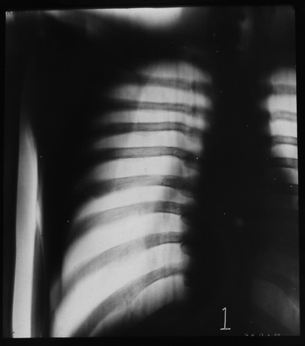 Xray human chest - of,