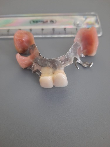 Zahnprothese/Gebiss/Zahnersatz