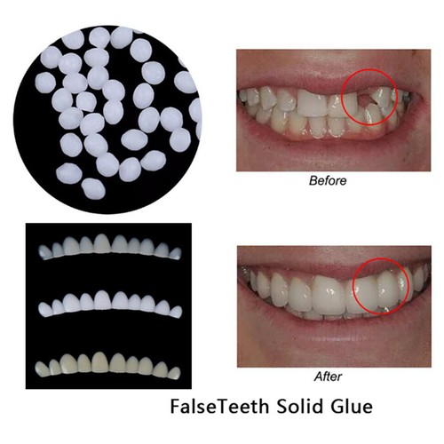 Dünne whitening veneers - dünne,