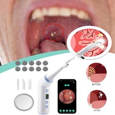Visible tonsil stone - stone, removal