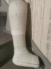 Gipsbein, Unterschenkelgips
