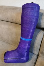 Gipsbein, Unterschenkelgips  Lila Links