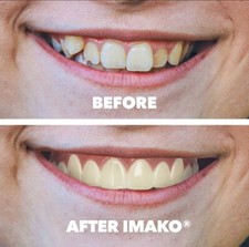 Temporärer Zahnersatz