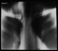 XRAY OF A HUMAN CHEST NO8
