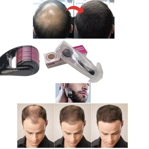 5mm derma roller 540 nadeln - 2.5mm,