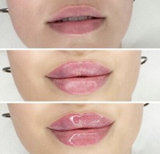 online schulung Hyaluron Pen 