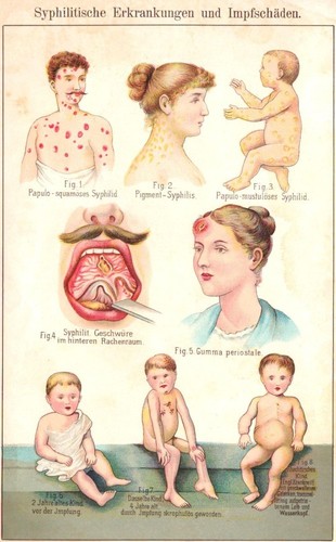 Syphilitische erkrankungenn - syphilitische,