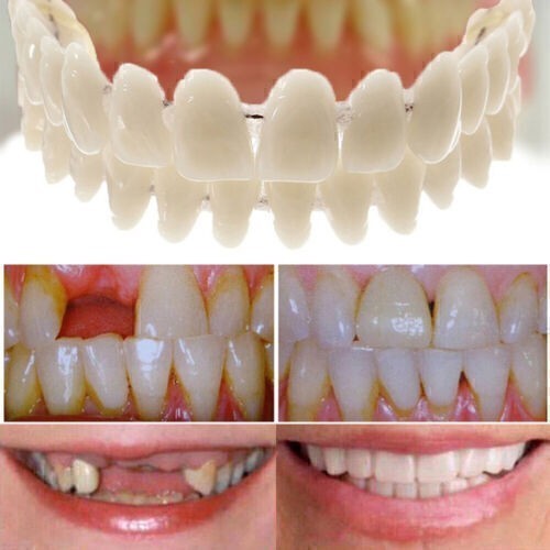 Snap veneers kosmetische - on,