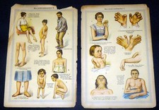 NERVENKRANKHEITEN Neurologie. Lithographie. 1924 Aus: BILZ Das neue Naturheilver