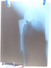 Finger Knochen Röntgenbild X2 - Menschliche Finger Röntgen - Medizinisches Negativfilmbild